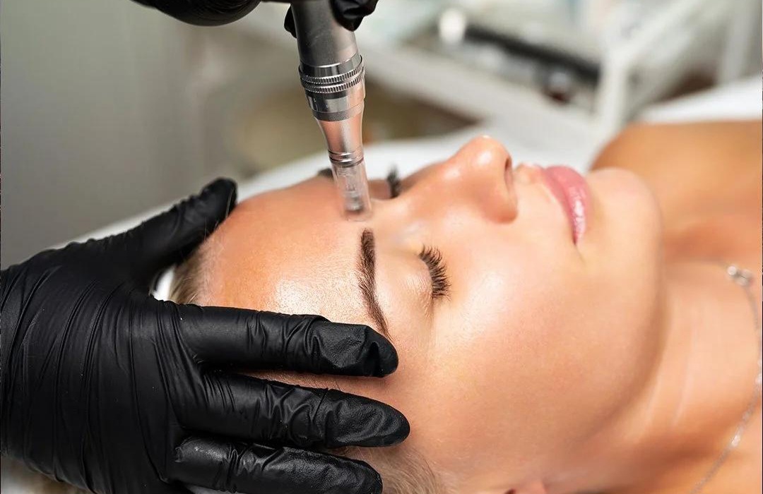 Microneedling Behandlung